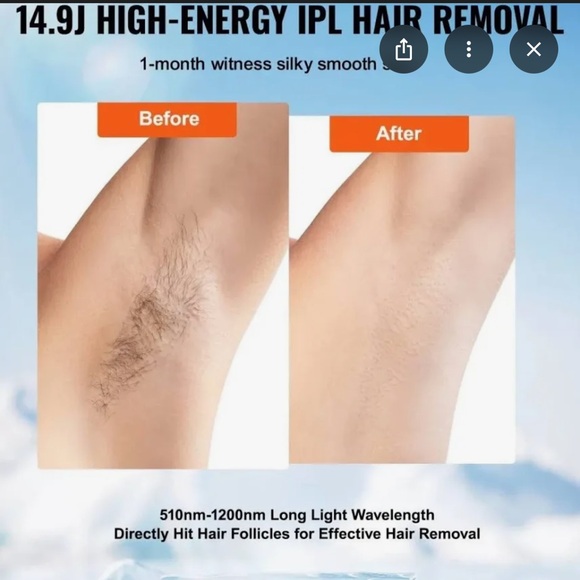 Permanent laser hair removal- Intense Pulsed Light (IPL) System - Picture 5 of 6